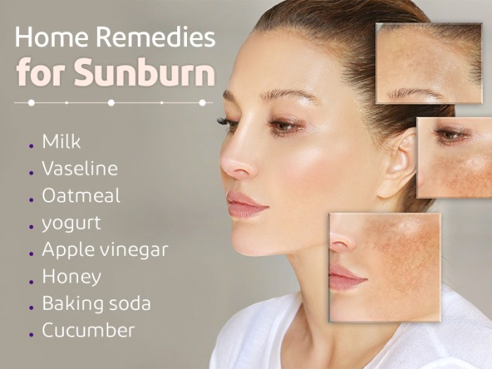 Sunburn remedies skin soothe sunburns