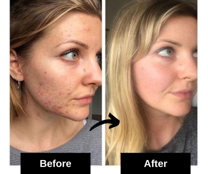 Acne remedies scars remove