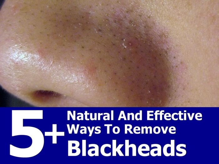 Blackheads remove natural effective ways face
